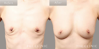 痩せ型の豊胸脂肪注入の(コンデンスリッチ豊胸)の症例画像6