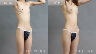 脂肪注入豊胸を受けたBMI値13の女性のバストと脂肪吸引箇所のビフォーアフター(ビブラ)」