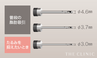 普段の脂肪吸引: φ4.6㎜ / φ3.7㎜ | たるみを抑えたいとき: φ3.0㎜