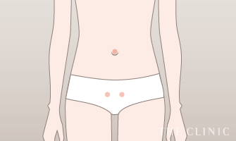 お腹の吸引箇所