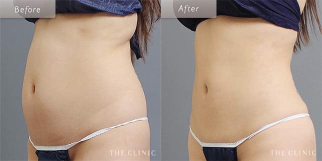 ぽっこりお腹をスッキリ(24歳)