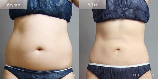 理想のくびれを手に入れる(23歳)