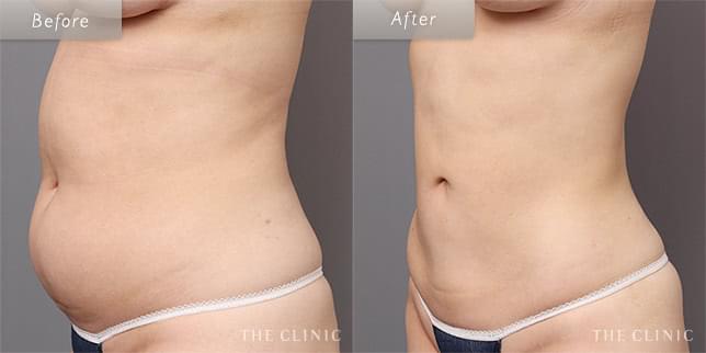 ダイエットとの相乗効果でスリムボディに(22歳)