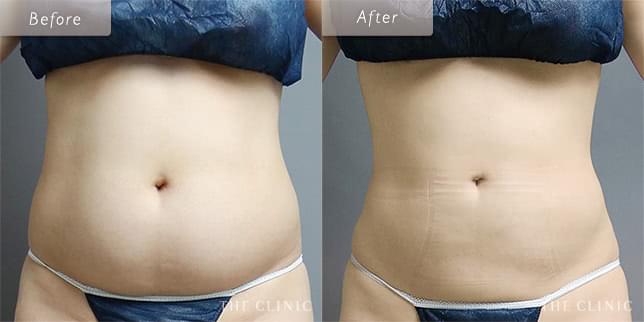 ぽっこりお腹から美ウエストへ(32歳)