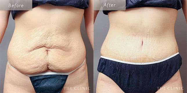 出産時の皮膚のたるみをスッキリ(28歳)