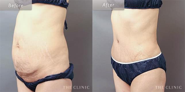 ぽっこりお腹をすっきり解消(48歳)