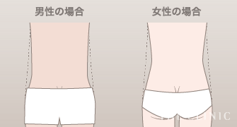 腰の脂肪吸引のデザインイメージ