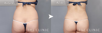 28歳女性(腰)のベイザー脂肪吸引の症例画像