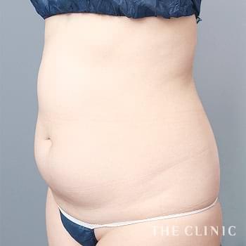 くびれ脂肪吸引の症例写真 | THE CLINIC（ザクリニック）【公式】