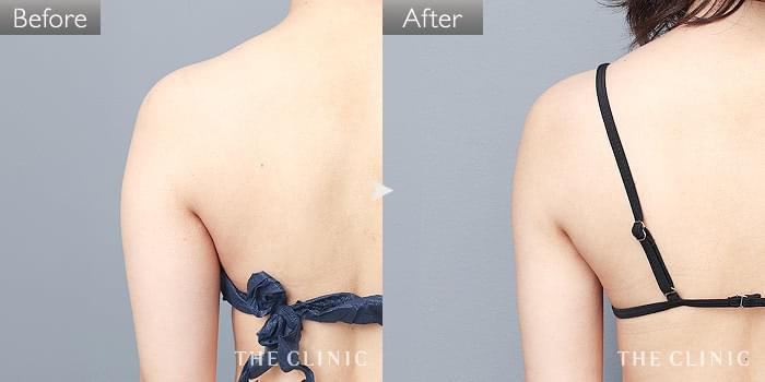 二の腕・肩の脂肪吸引｜脂肪吸引専門のTHE CLINIC