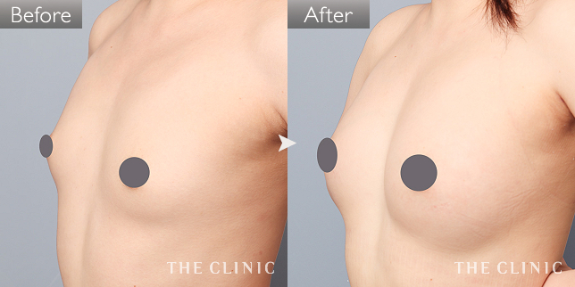 コンデンスビブラ豊胸｜THE CLINIC （ザクリニック）【公式】