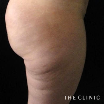 セルライトの除去 The Clinic ザクリニック 公式