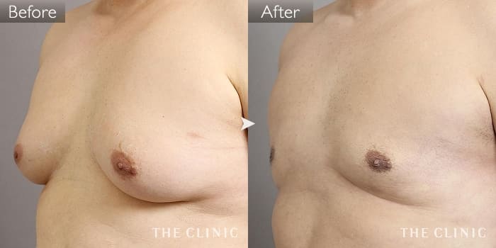 男性の脂肪吸引 The Clinic ザクリニック 公式