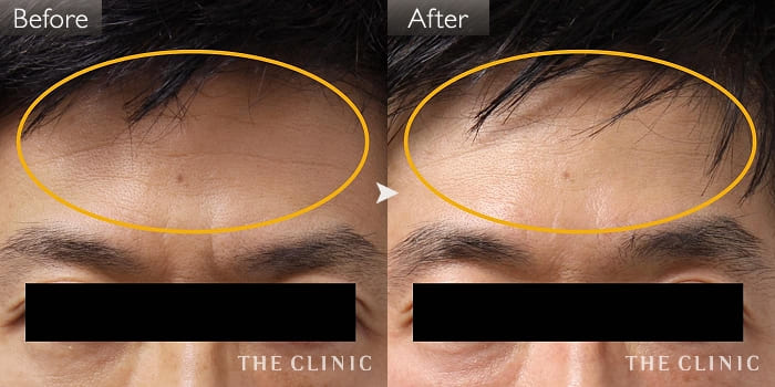 おでこ 額 のシワ取り The Clinic ザクリニック 公式