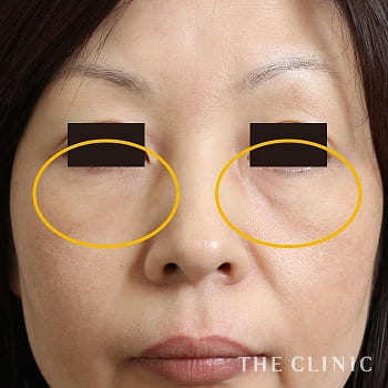 目の下のたるみ取り The Clinic ザクリニック 公式