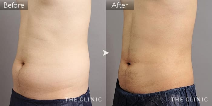 男性の脂肪吸引 The Clinic ザクリニック 公式