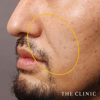 ほうれい線を消すならthe Clinic ザクリニック 公式