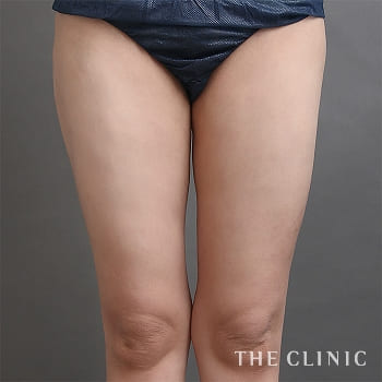 膝の脂肪吸引 たるみ取り The Clinic ザクリニック 公式
