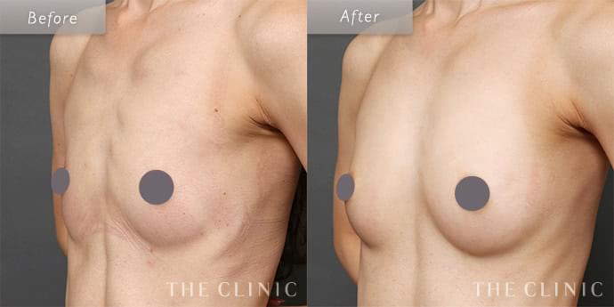 豊胸手術・バストアップ｜美容外科THE CLINIC