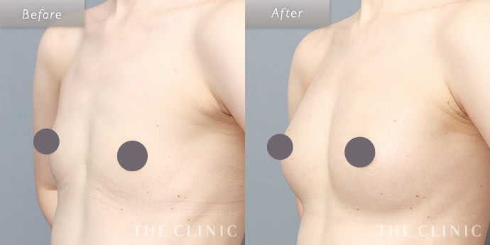 豊胸手術・バストアップ｜美容外科THE CLINIC