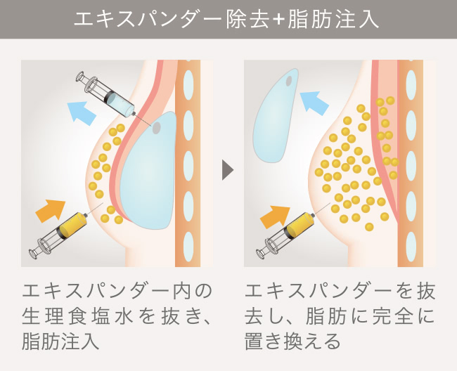脂肪注入による乳房再建｜THE CLINIC （ザクリニック）【公式】