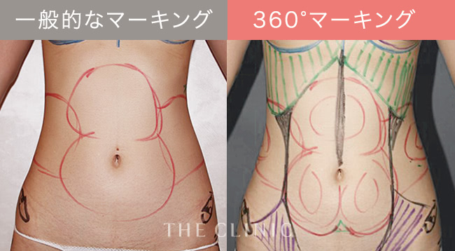 コンデンスリッチ豊胸｜THE CLINIC （ザクリニック）【公式】