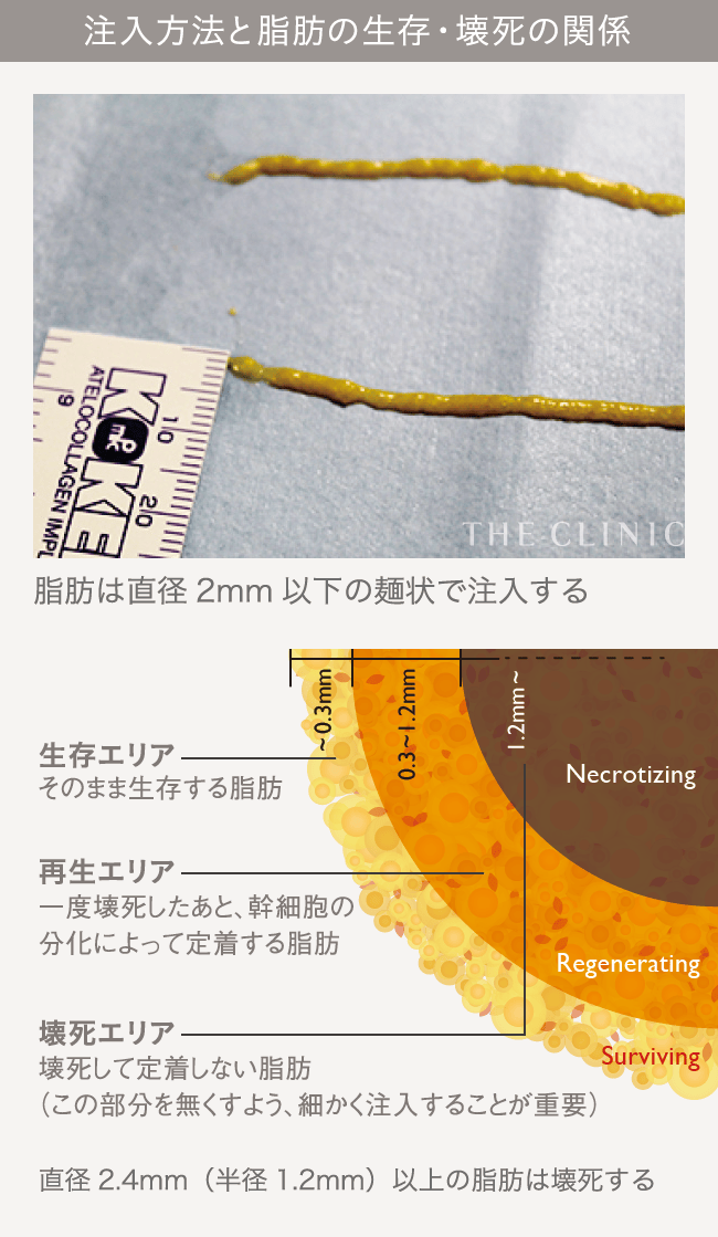 ★最終値下げ★ビブラ 豊胸 THE CLINIC 医療機器 コンデンスビブラ豊胸｜THE CLINIC （ザクリニック）【公式】