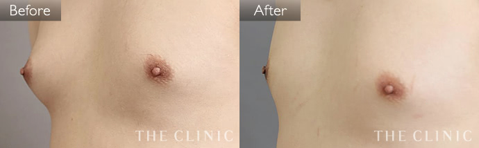 乳首 膨らみ 女性化乳房の治療|THE CLINIC - ザクリニックの得意分野