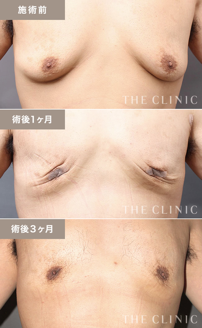乳首 膨らみ 女性化乳房の治療|THE CLINIC - ザクリニックの得意分野