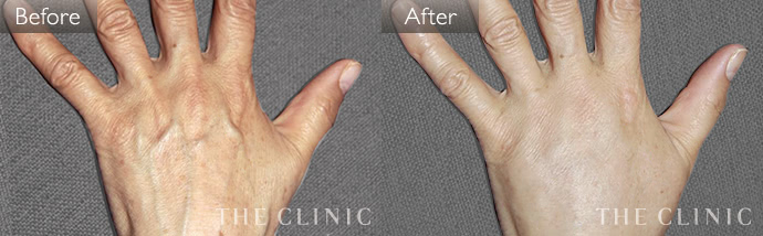 手の甲への脂肪注入 ハンドリバイブ The Clinic 公式