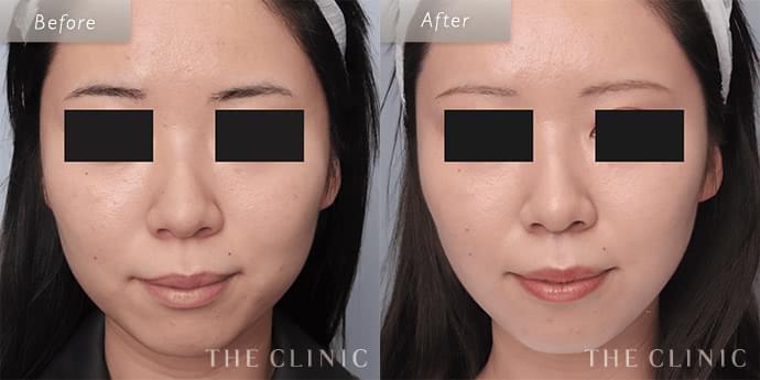 ヒアルロン酸＋安全で失敗しない脂肪吸引の手術 THE CLINIC 安全で失敗しない脂肪吸引の手術 | 大橋 昌敬, 志田 雅明, 今西 理也