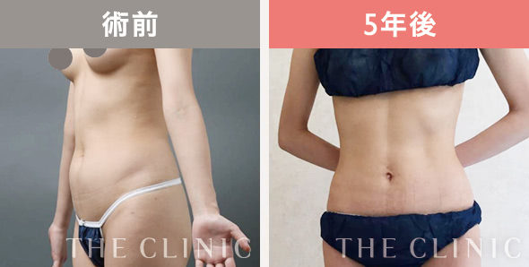 脂肪吸引｜美容外科のTHE CLINIC