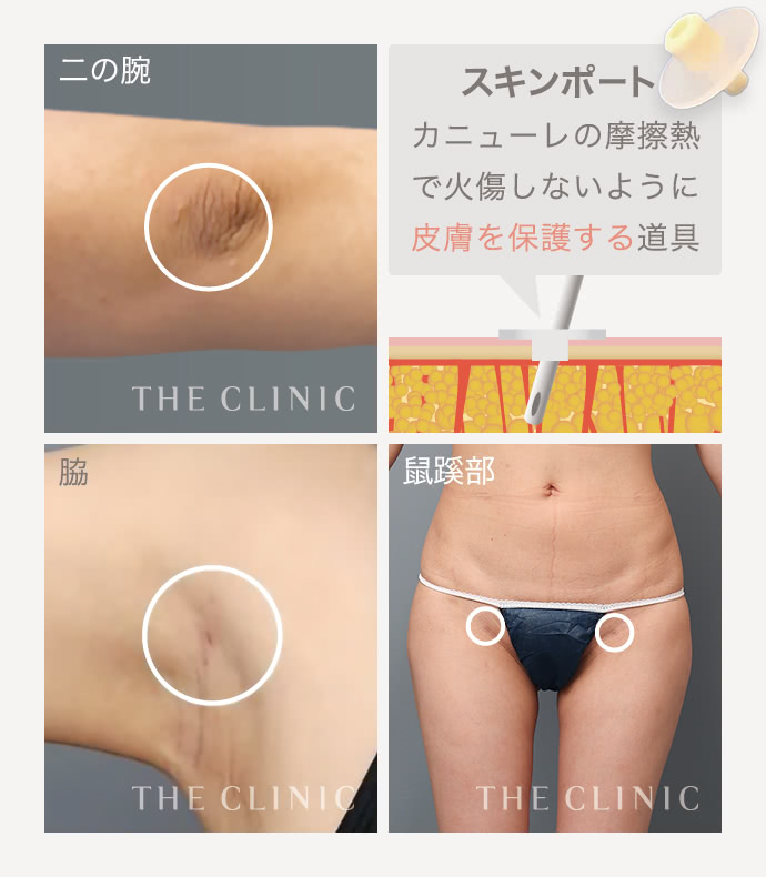 脂肪吸引｜美容外科のTHE CLINIC