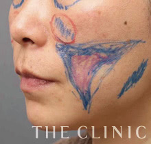 マイクロcrf注入 顔の脂肪注入 The Clinic 公式