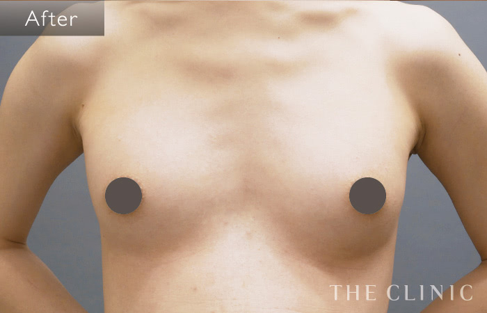 Mtfの豊胸 ボディデザイン 男性豊胸 The Clinic ザクリニック 公式