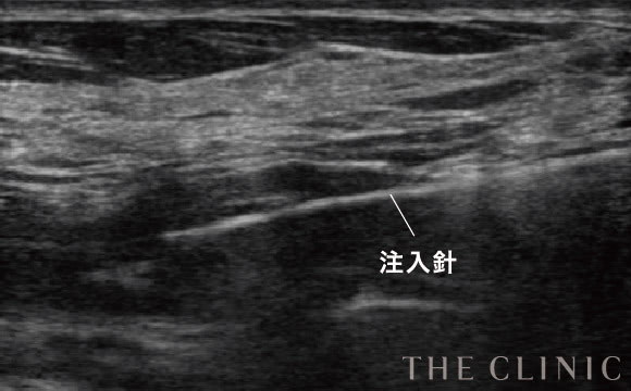 アクアフィリング豊胸除去 The Clinic ザクリニック 公式