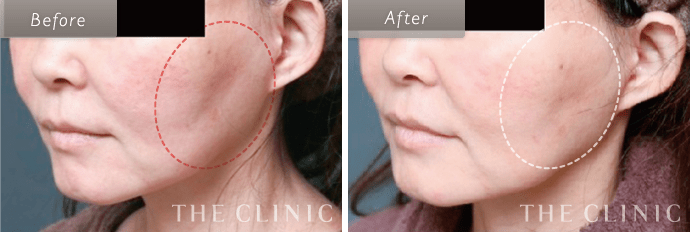 ヒアルロン酸＋安全で失敗しない脂肪吸引の手術 THE CLINIC 裁断済み】安全で失敗しない脂肪吸引の手術 THE CLINIC 公式】THE