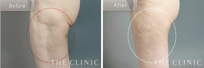 脂肪吸引の失敗修正【顔／お腹／太もも／お尻／ふくらはぎ】｜ザ