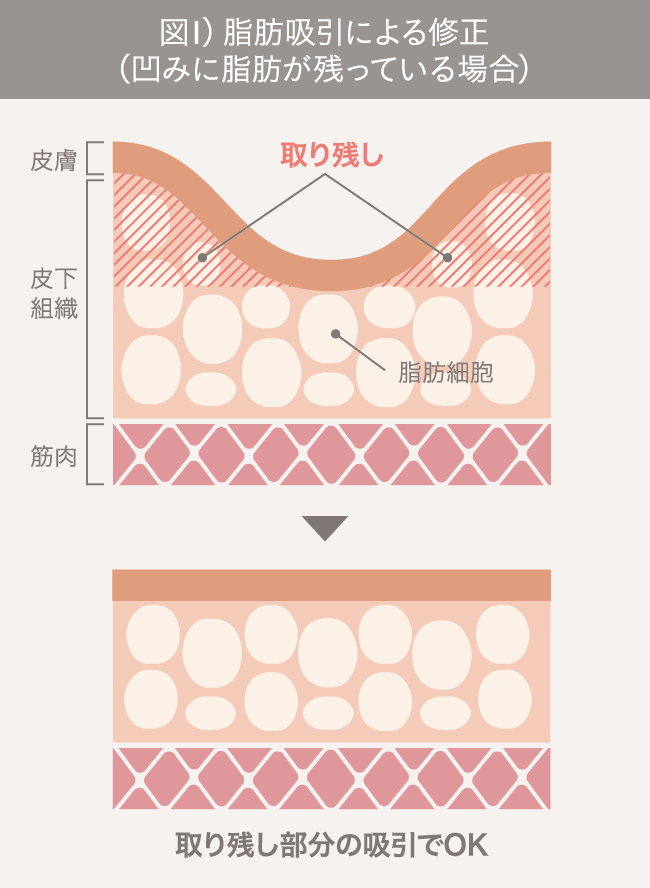 脂肪吸引の失敗修正【顔／お腹／太もも／お尻／ふくらはぎ】｜ザ