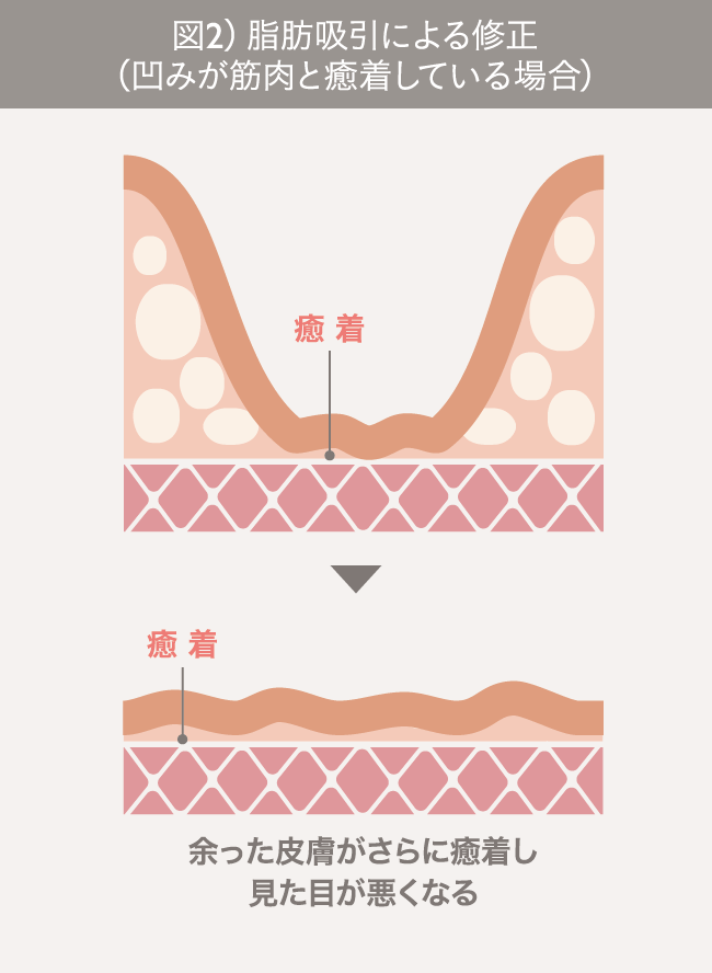 脂肪吸引の失敗修正【顔／お腹／太もも／お尻／ふくらはぎ】｜ザ