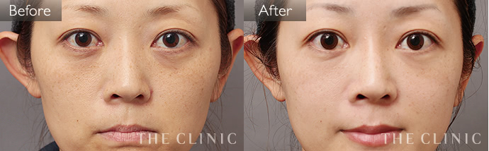 Very sticky facial sebum, flaky face - 専門家による効果的な治療法