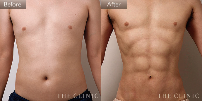 脂肪吸引器 純脂肪4000cc吸引で、腹囲マイナス14cmの衝撃！ 気に