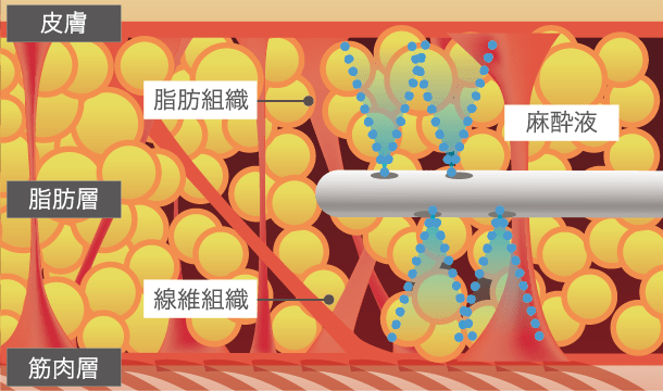 ベイザー脂肪吸引 ベイザーリポ The Clinic 公式