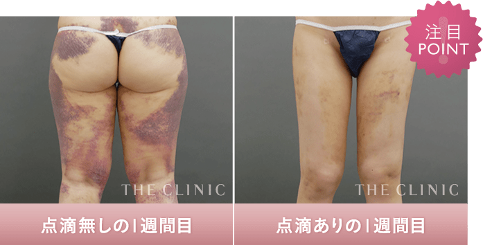 THE CLINIC の術後ケア【脂肪吸引後のダウンタイムを軽減】