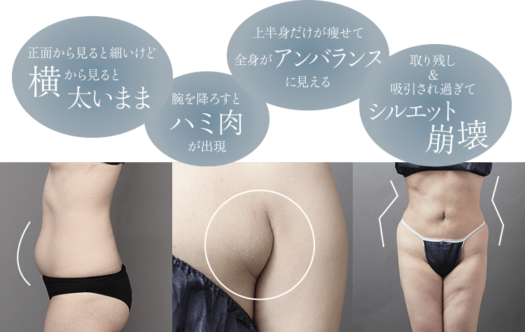 正面から見ると細いけど横から見ると太いまま｜腕を下ろすとハミ肉が出現｜上半身だけが痩せて全身がアンバランスに見える｜取り残し＆吸引されすぎてシルエット崩壊