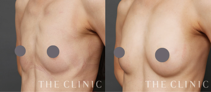 THE CLINIC ザクリニック　ガードル　脂肪吸引　豊胸　圧迫着　着圧着 脂肪吸引術後の圧迫固定は大変？ 気になる時期とガードル着用