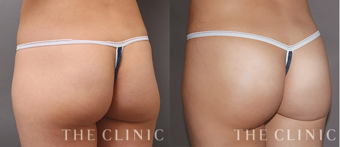 豊胸のモニター募集ページ The Clinic ザクリニック 公式