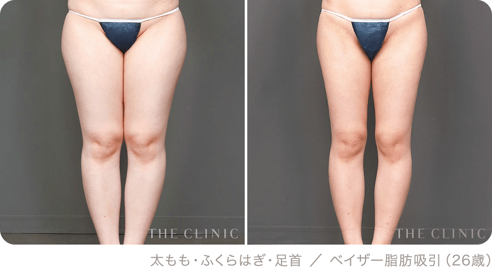太もも・ふくらはぎ・足首 ／ ベイザー脂肪吸引（26歳）