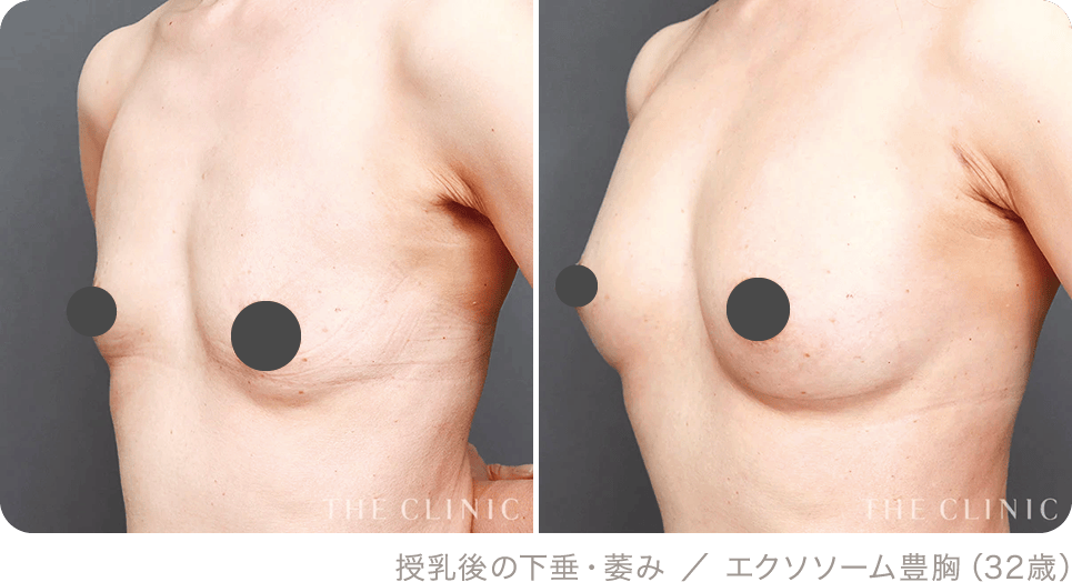 授乳後の下垂・萎み ／ エクソソーム豊胸（32歳）