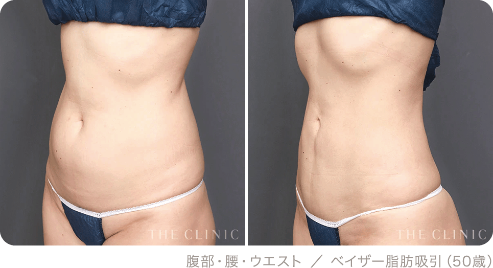 腹部・腰・ウエスト ／ ベイザー脂肪吸引（50歳）